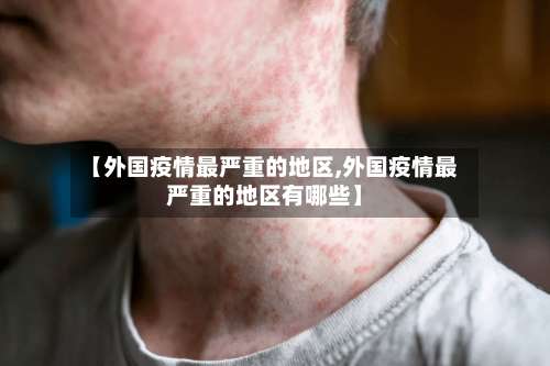 【外国疫情最严重的地区,外国疫情最严重的地区有哪些】-第2张图片